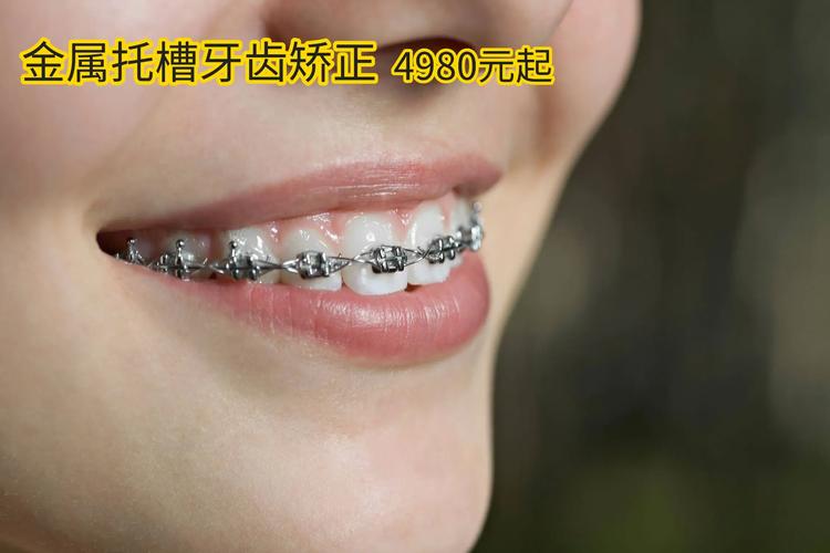 牙齿矫正整齐需要多少钱_不整齐牙齿矫正_牙齿矫正整齐后多久去掉牙箍