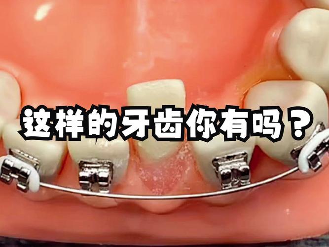 上海8岁小孩牙齿歪了能矫正吗 家长别错过最佳时机