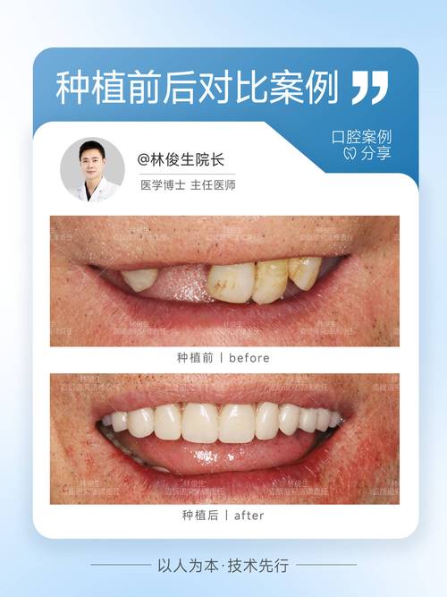 上海深圳坪山种一颗牙多少钱 价格明细来了