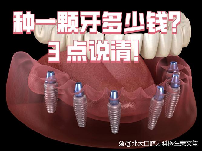 上海沈阳种牙2026年单颗多少钱？3000到5200元能搞定吗