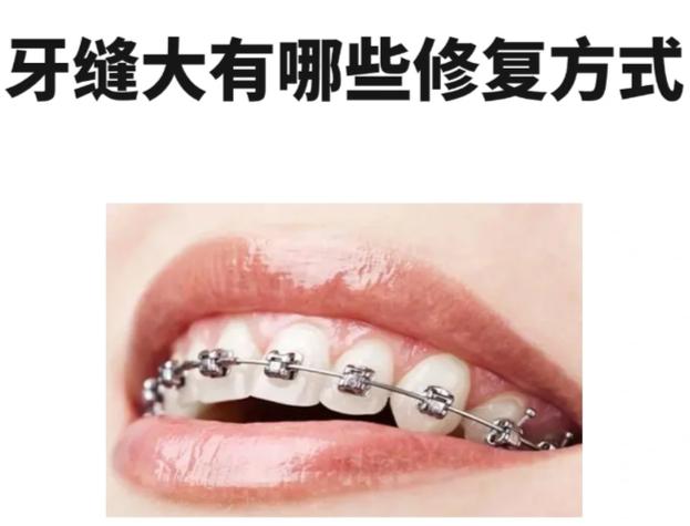 矫正报价深圳牙缝过大的医院_牙科矫正牙缝大手术视频_深圳牙缝过大矫正报价