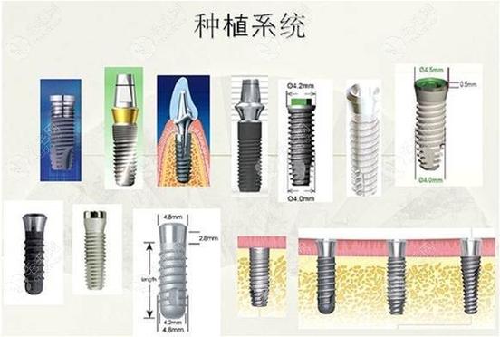 上海种植牙国产韩系欧美价格对比,哪个品牌性价比高?
