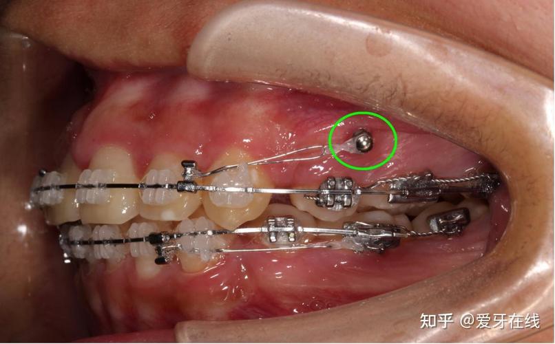 上海20多岁矫正牙齿会后悔吗？医生说大实话