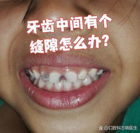 上海门牙有缝怎么矫正？这几种方法亲测有效