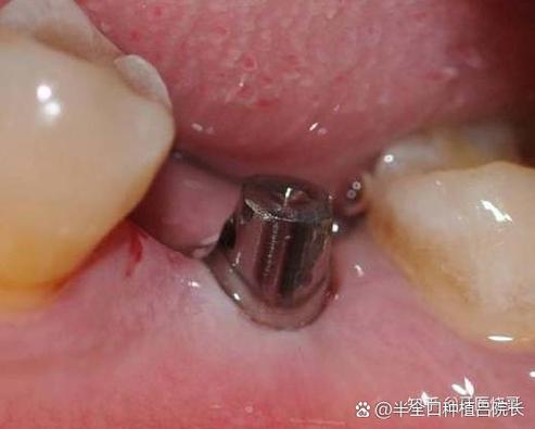 上海65岁老人牙齿还能种吗？种牙靠谱吗