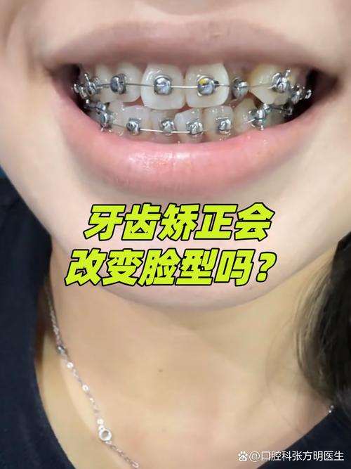 上海18岁龅牙能矫正吗 成人正畸看这篇就够