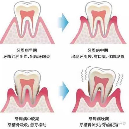 上海三十岁还能整牙吗？成人牙齿矫正必知真相