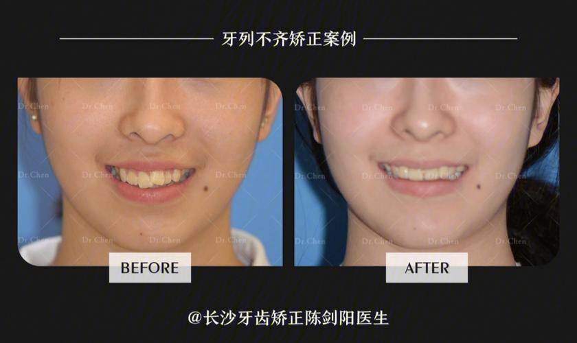 上海拔门牙矫正牙齿会松动吗？正畸医生说出大实话