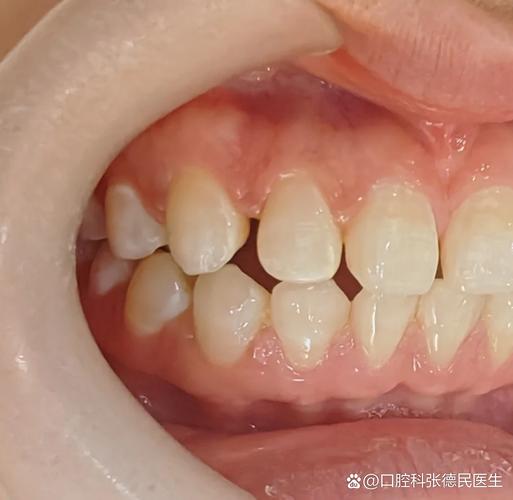 上海深圳牙缝过大矫正多少钱？最新价格一览