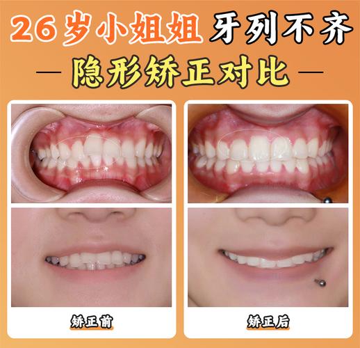 上海北京舌侧矫正靠谱吗？价格/医院/医生全揭秘