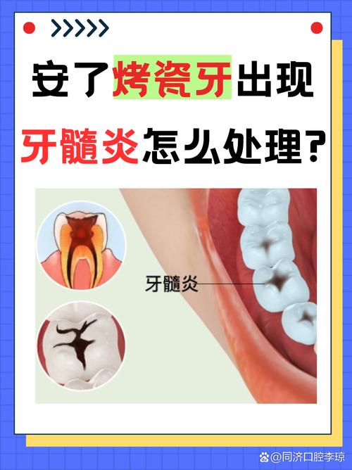 上海牙医良心忠告：做烤瓷牙前这两点不注意，当心毁了整口牙