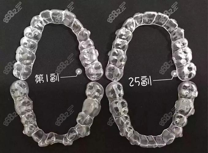 上海深圳隐适美矫正费用全公开 花多少钱心里有数