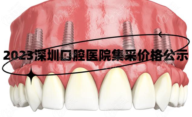 上海深圳种牙集采落地,到底能省多少钱?