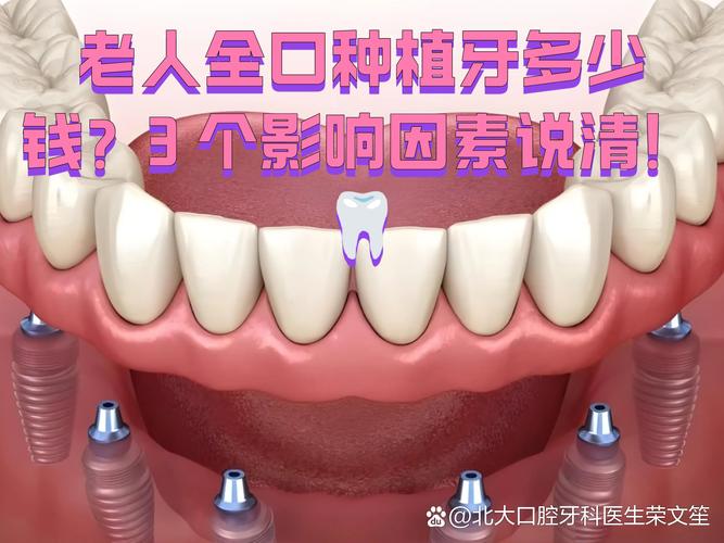 上海深圳老人全口种牙费用明细 深圳全口种植牙价格参考