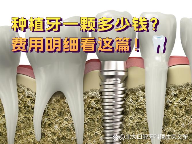 上海西安种牙2026年最新报价：单颗2600到4900元真实情况揭秘