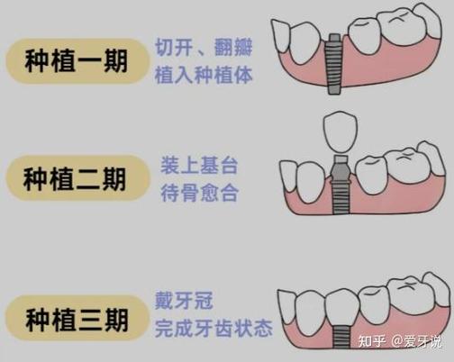 上海杭州种植牙骨粉贵不贵？要补多少？