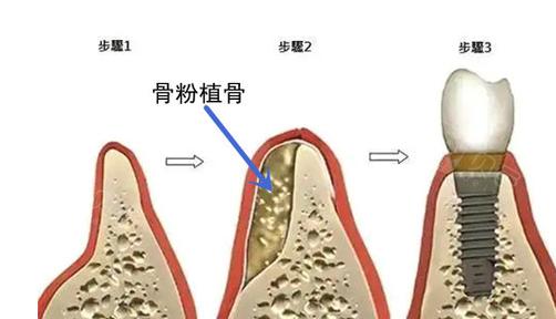 种牙骨粉收费多少钱_杭州种植牙骨粉_种牙骨粉收费标准最新