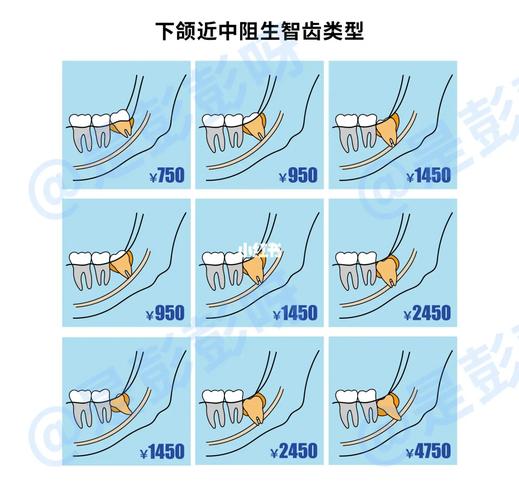 上海杭州口腔医院拔牙要花多少钱？怎么选才不踩坑？