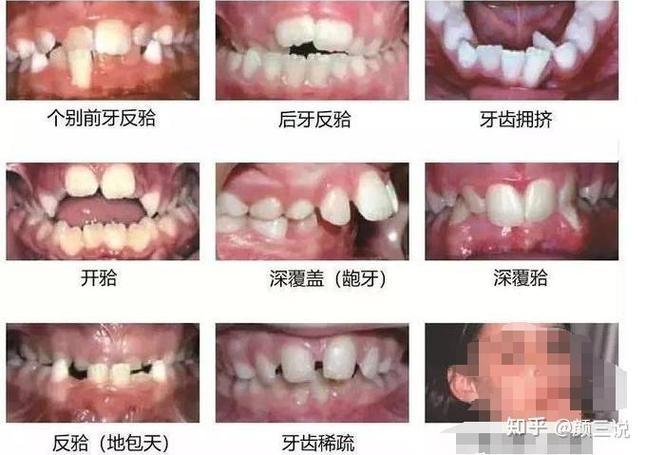 上海青岛儿童几岁做正畸最好？多少钱？
