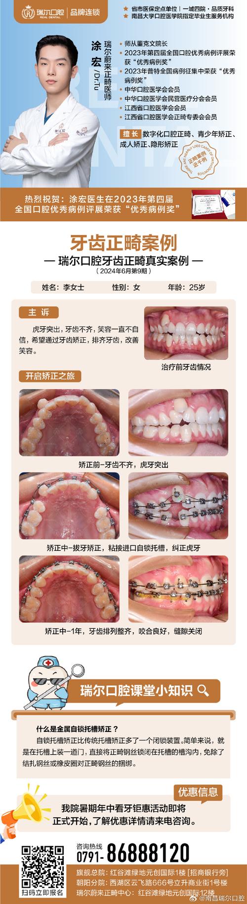 上海成人龅牙矫正选医院还是诊所?关键看医生资质和案例对比