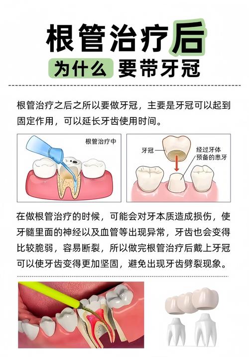 上海根管治疗补牙到底怎么回事?医生详解步骤和必要性