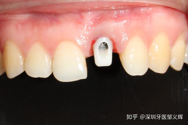 上海大牙坏了还能马上种吗？牙医揭秘即拔即种的真相与风险