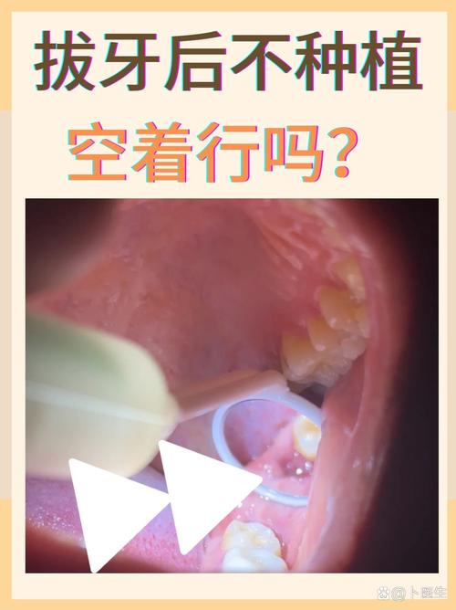 上海成人拔牙后必须种牙吗？不种牙的后果，医生告诉你真相