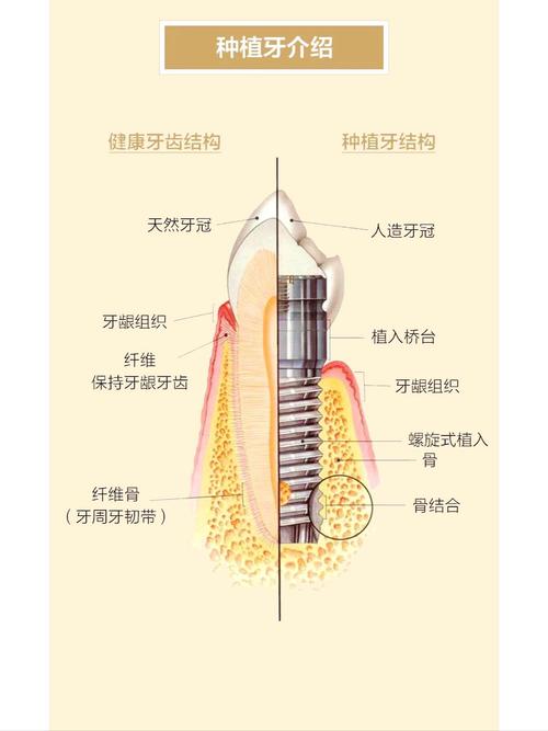上海什么叫种植牙齿 一篇讲清原理过程
