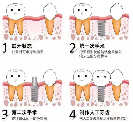 上海种植牙全过程揭秘：从挂号到戴牙多久？