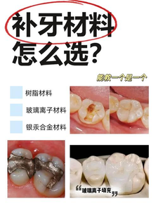 补牙补缝_补牙会不会越补越坏_补牙缝费用