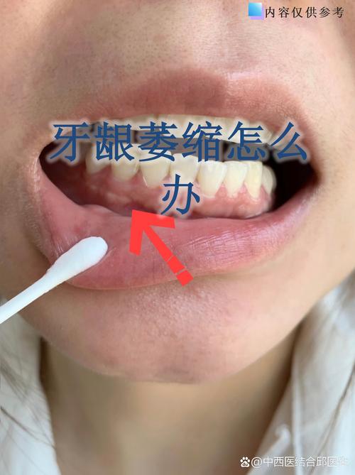 上海缺牙不补的严重后果：邻牙倾斜松动，对牙伸长，牙槽骨萎缩