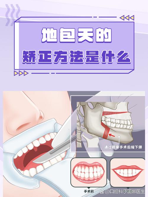 正畸可以改变地包天吗_牙齿矫正可以矫正地包天吗_45岁地包天牙齿能纠正