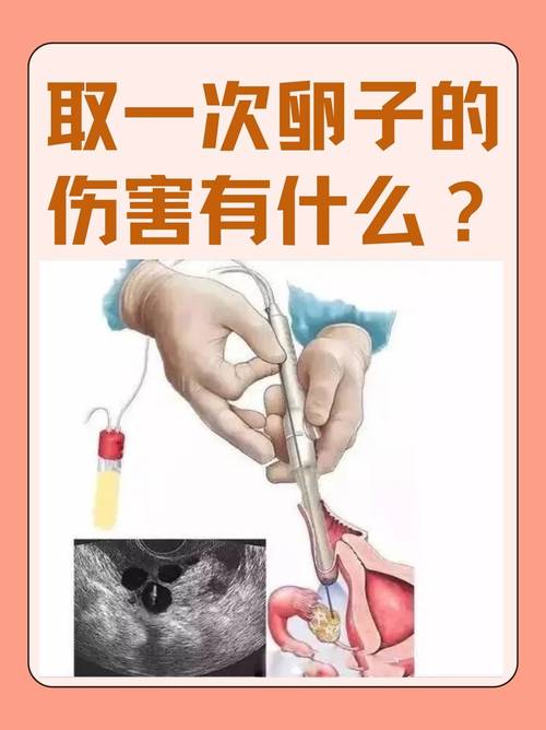上海取卵麻醉到底疼不疼 会不会影响卵子质量 医生一次说清