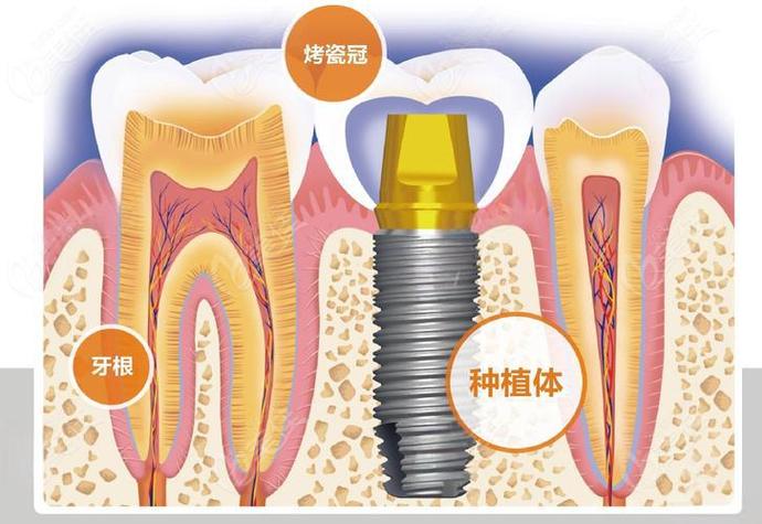 上海赤峰种牙费用详解：从预算到效果，给您的实惠指南