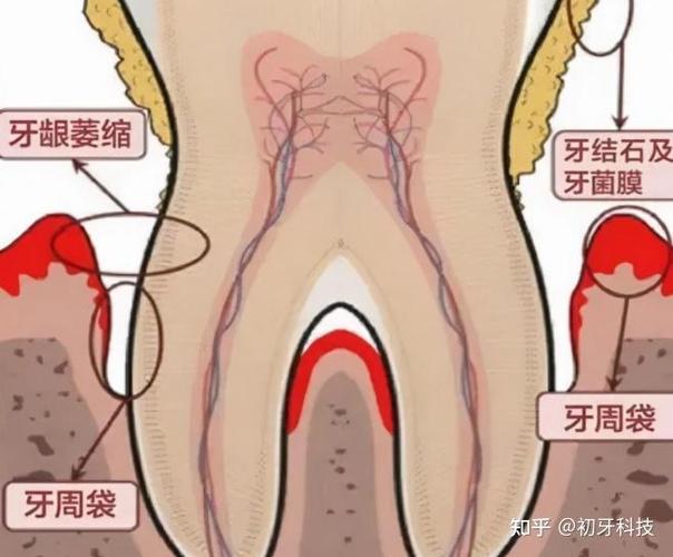 上海贵阳种植牙2026年单颗3500到5500元贵吗