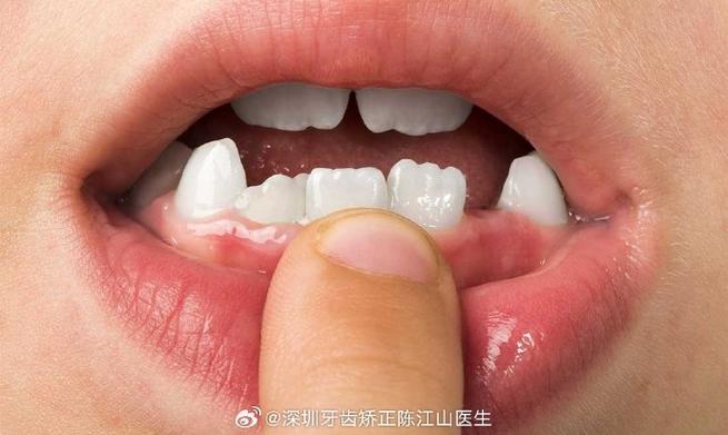 上海小孩牙齿长成锯齿状，到底严重不严重？