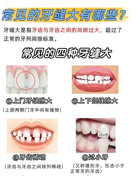 上海矫正牙齿门牙缝隙变大了?医生告诉你正常吗咋应对