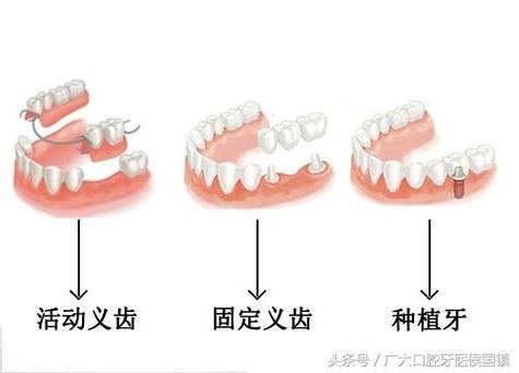 上海北京种牙失败修复多少钱？游离体取出需花费多少？