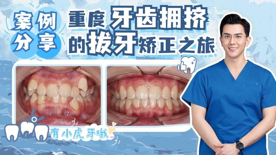 上海告别“虎牙”尴尬,快速矫正重塑自信笑容