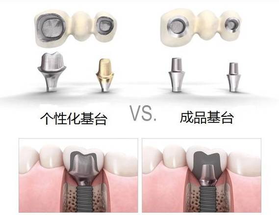 上海缺牙后选进口还是国产种植体？到底哪个更划算？