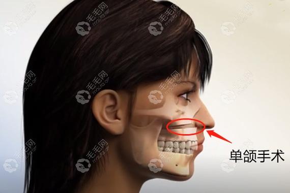 上海深圳成人骨性龅牙矫正到底要花多少钱？