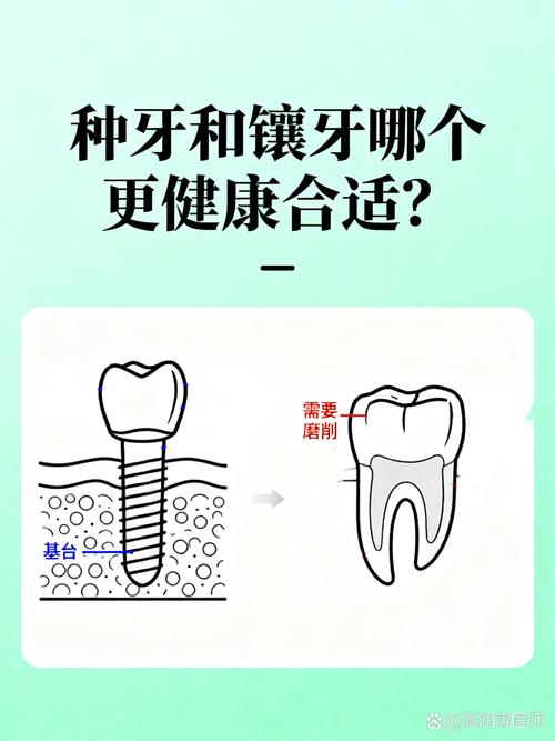 上海25岁镶牙还是种牙好？别磨坏好牙，年轻人种牙是长期投资