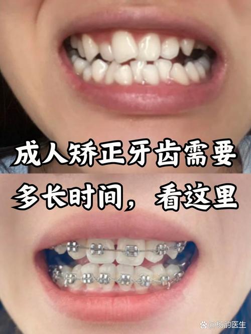 上海18岁还能矫正牙齿吗?成人牙齿矫正晚不晚