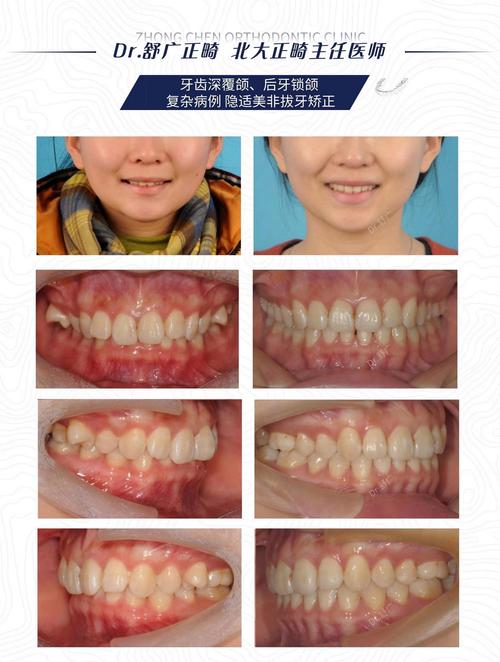 上海30岁后矫正深覆合?成人正畸完全可行