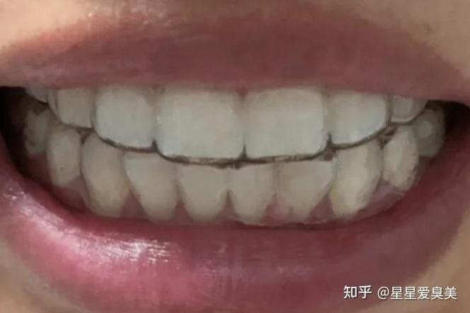 上海牙齿矫正30岁开始晚吗？过来人分享真实经历与经验