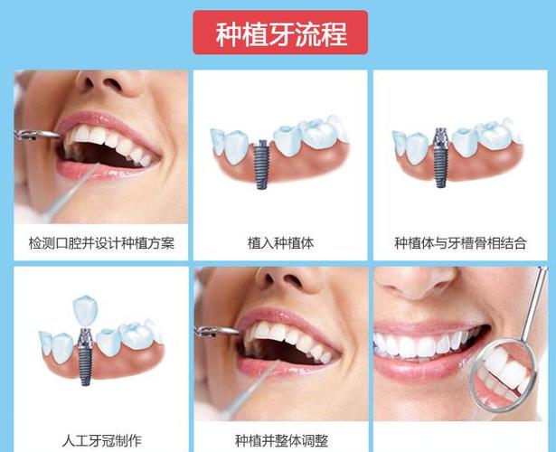 上海深圳罗湖骨量不足全口种牙多少钱？费用明细来了