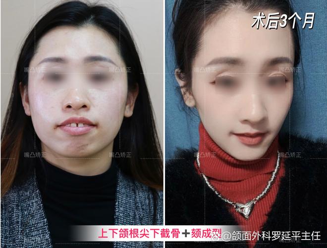 上海凸嘴矫正真能靠整牙改变？来看真实效果
