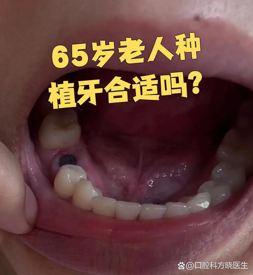牙种植可以一次性做完吗_60岁可以种植牙_我说种植牙可不可以弄