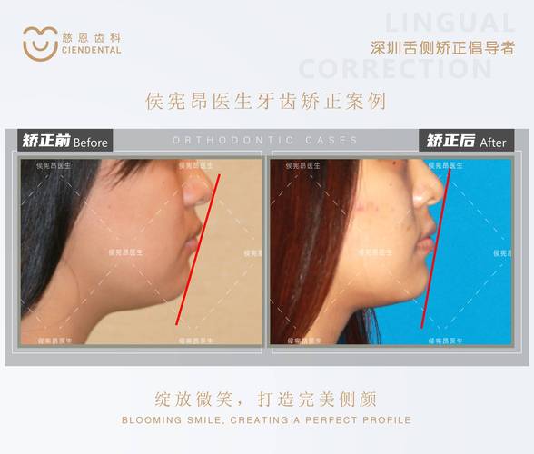 上海为什么24岁做牙齿矫正效果更好