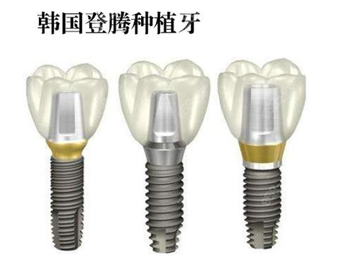 上海株洲种牙哪家强？公立医院性价比之选